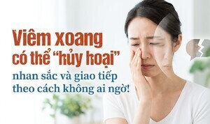 Viêm xoang có thể 