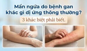 Mẩn ngứa do bệnh gan khác gì dị ứng thông thường? 3 khác biệt