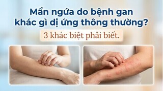 Mẩn ngứa do bệnh gan khác gì dị ứng thông thường? 3 khác biệt