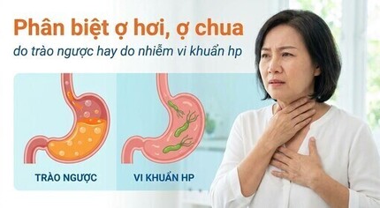 Phân biệt ợ hơi, ợ chua do trào ngược hay do nhiễm vi khuẩn hp