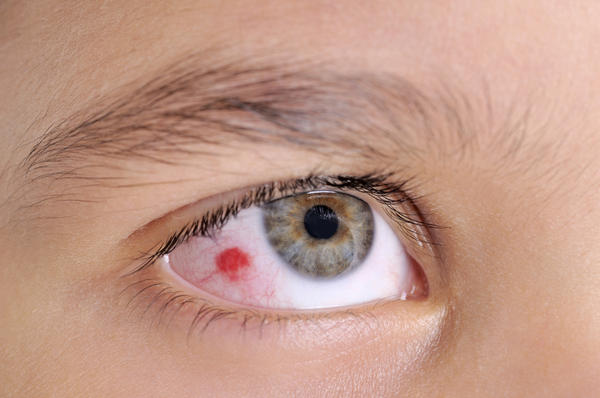 Chữa bệnh tụ máu mắt cần nắm rõ nguyên nhân trước